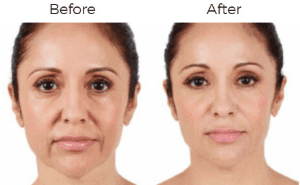 juvederm Before & After Image