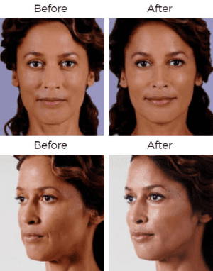 juvederm Before & After Image