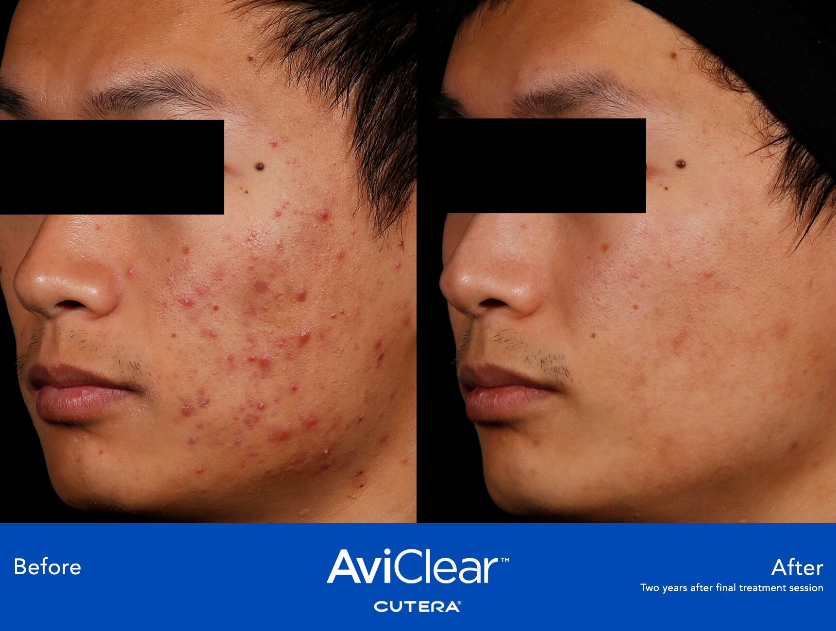 Aviclear Before & After Image