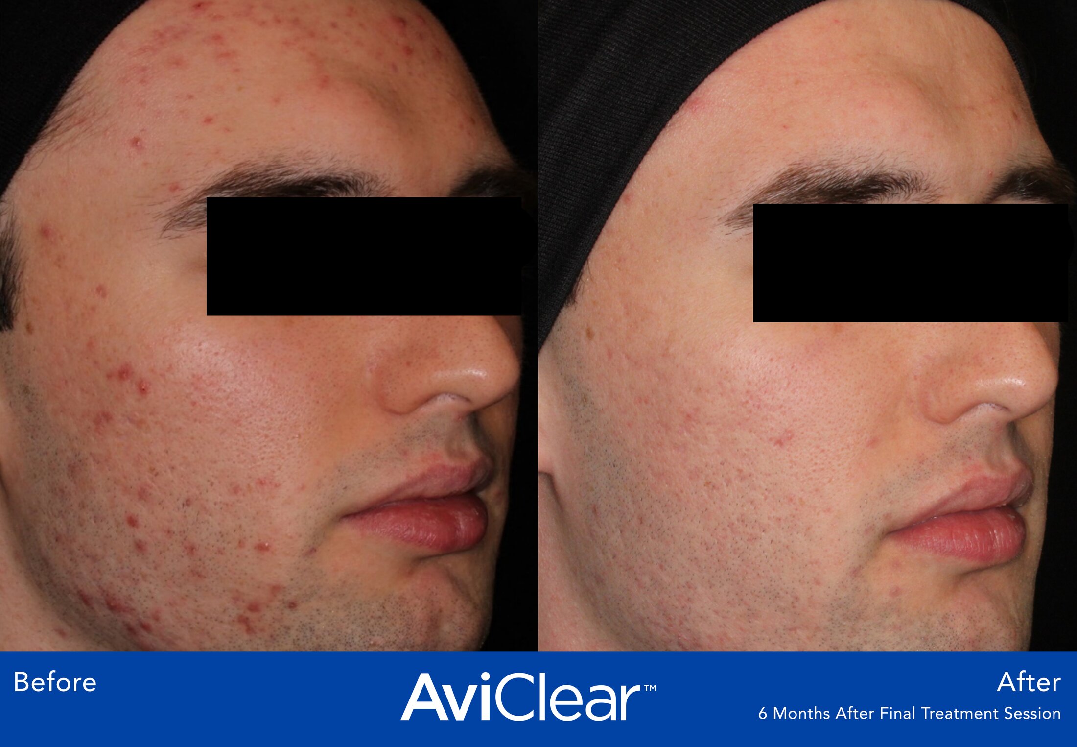 Aviclear Before & After Image
